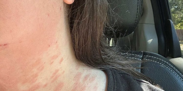 How A DIY Venture Destroyed My Pores and skin For Over Six Weeks (And The Residence Enchancment Retailer Product That Lastly Helped It Heal)